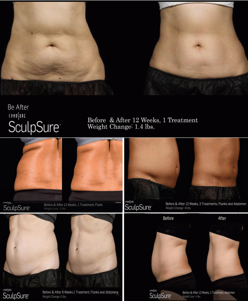 5 before and after clients taken body sculpting