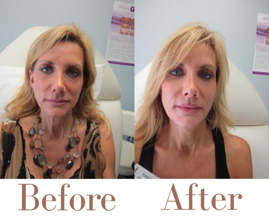 A woman before and after using nectifirm
