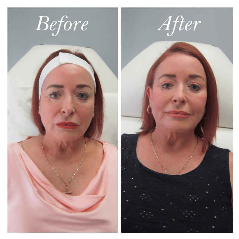 before and after of a woman's thread lift session