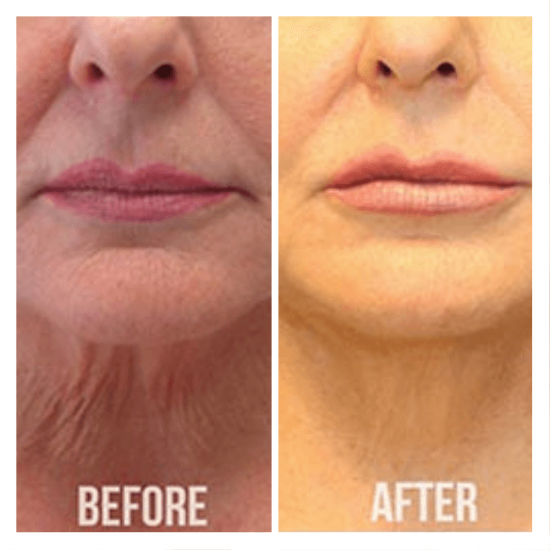 before and after of a chin thread lift