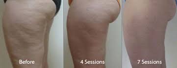 a leg result per sessions after skin tightening