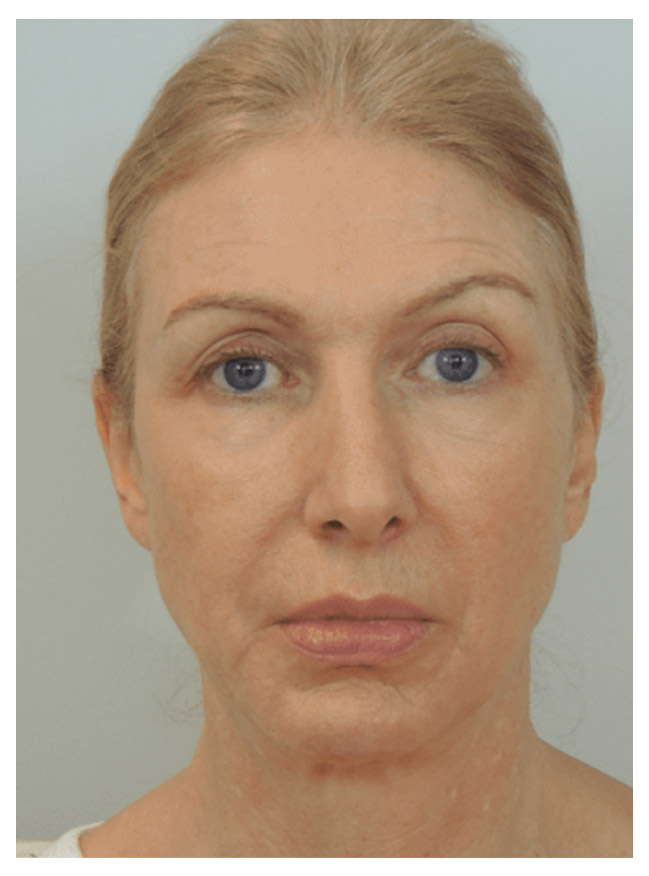 close up portrait of patient 2 before having restalyne