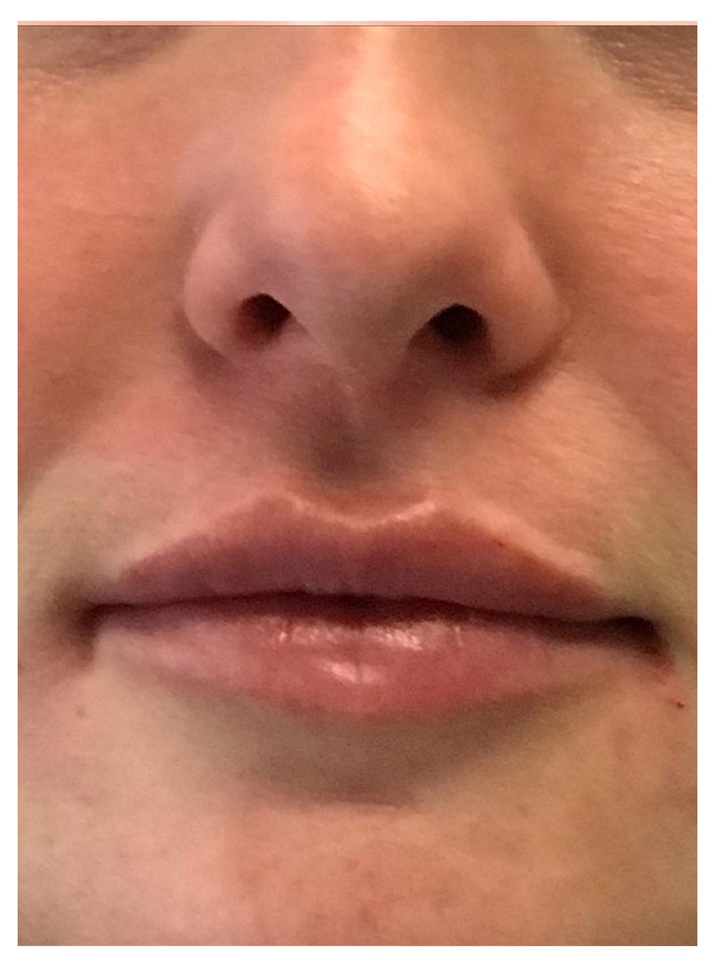 close up of a first patient's nose and lips after having a juvederm