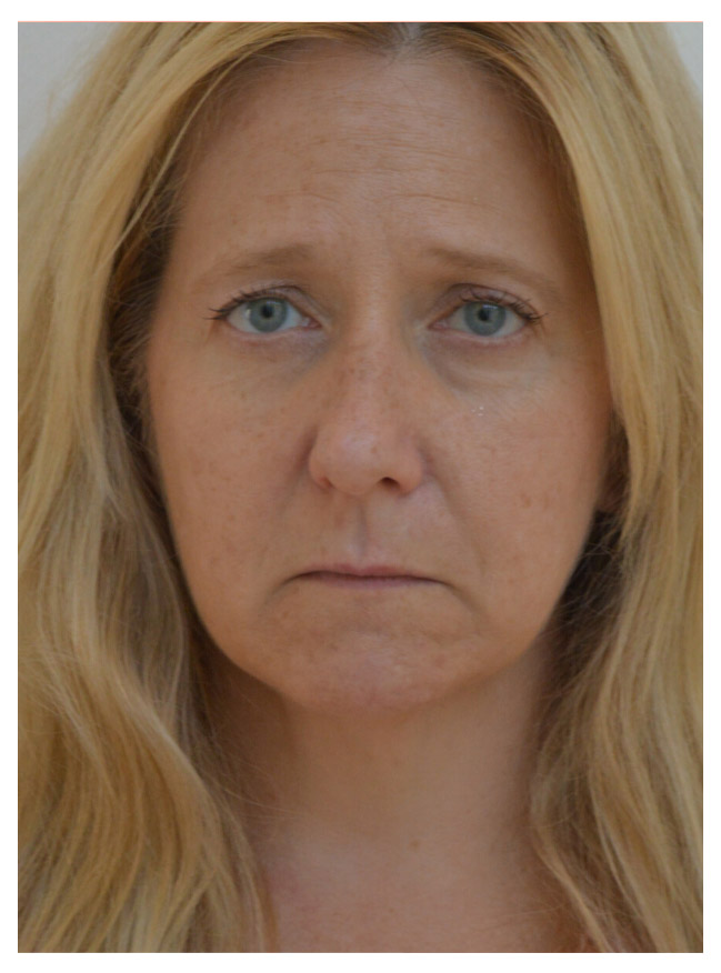 close up portrait of a patient before having a juverderm
