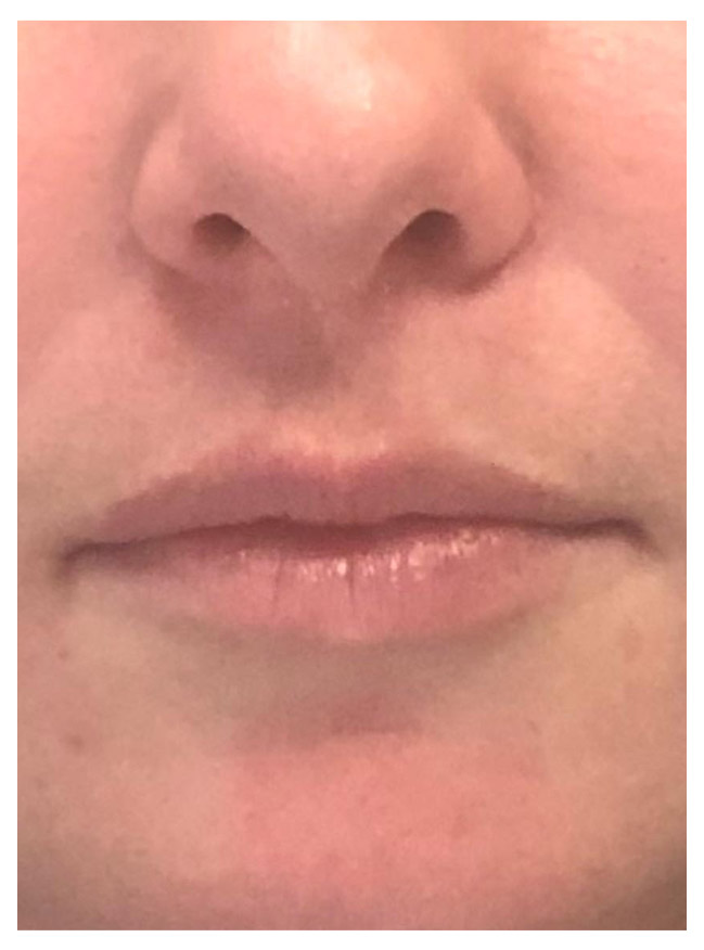 close up of a first patient's nose and lips before having a juvederm