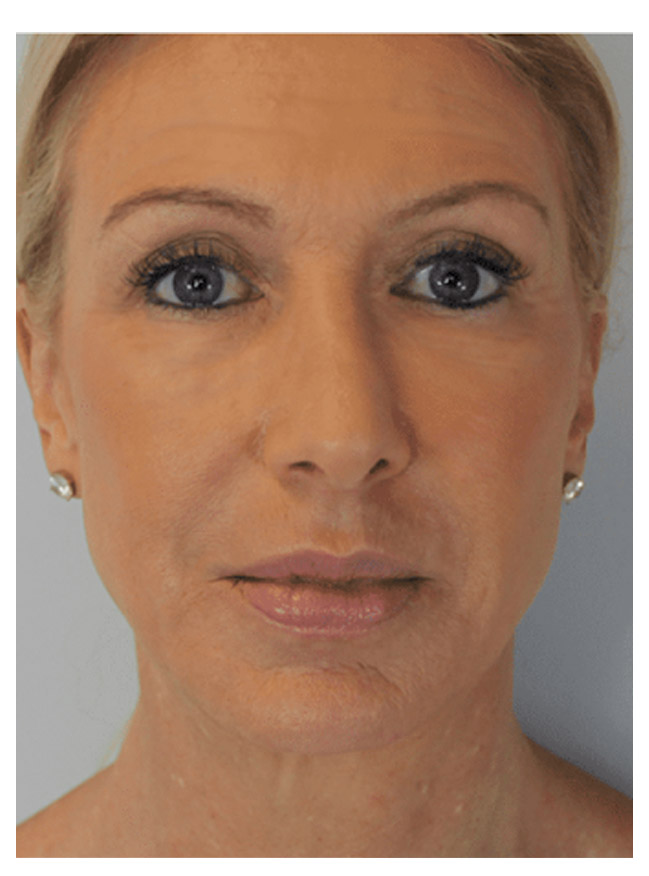 close up portrait of patient 2 after having restalyne
