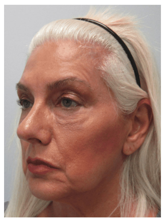 close up face portrait of a patient before having an under eyes treatment