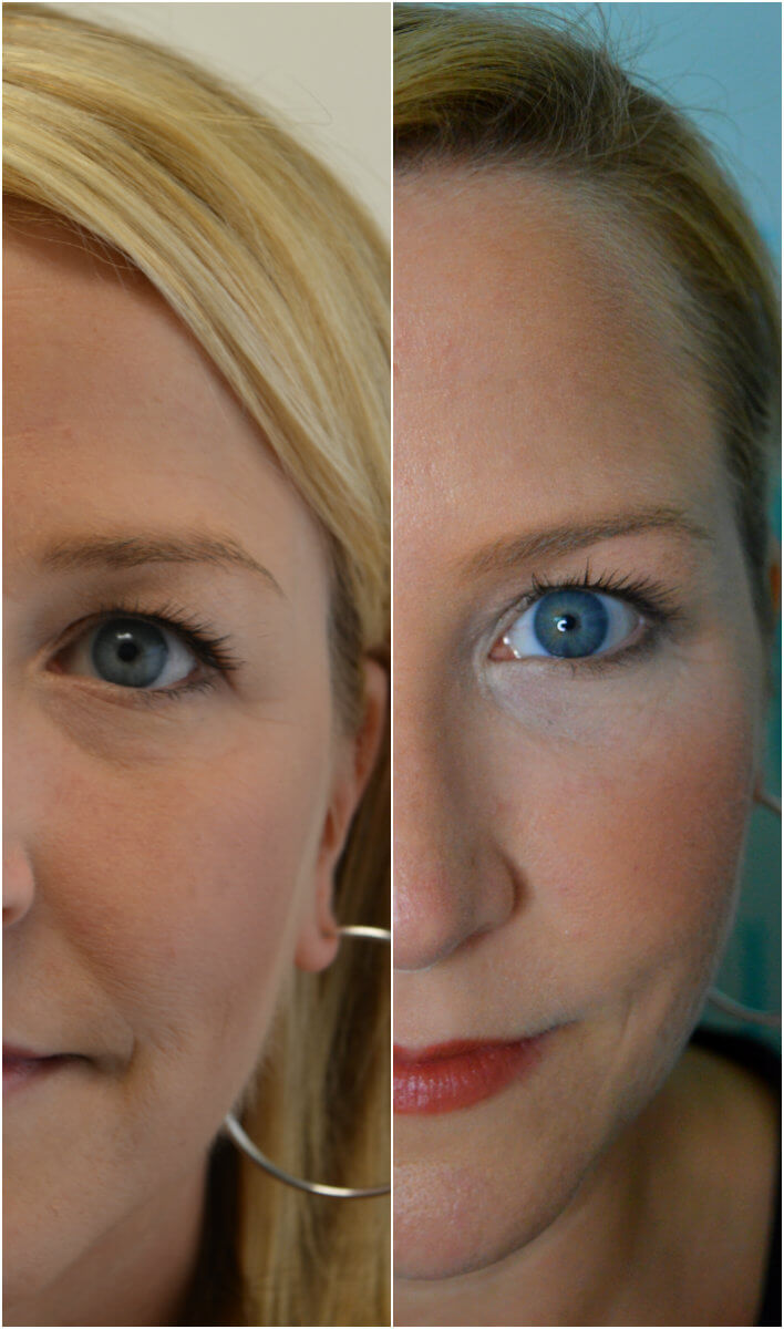 The Benefits of Thread Lifts - Anushka Salon & Spa