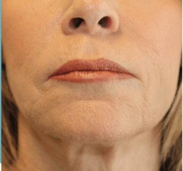before and after of a lip and chin thread lift