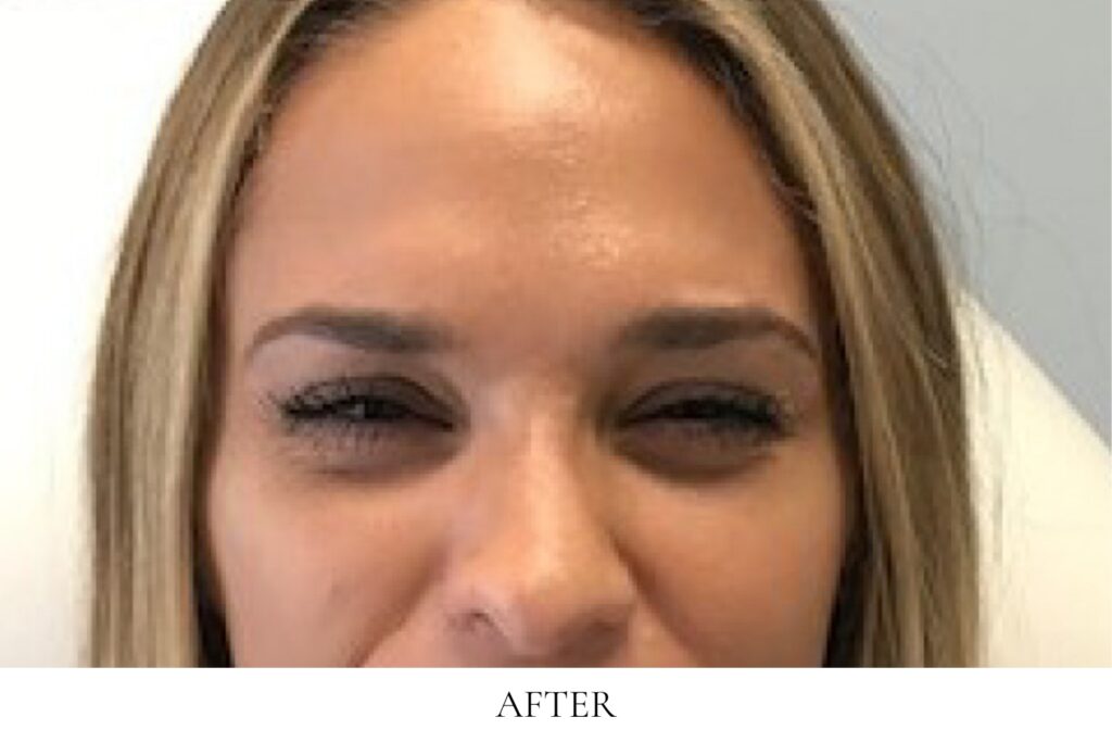 Botox before and after image