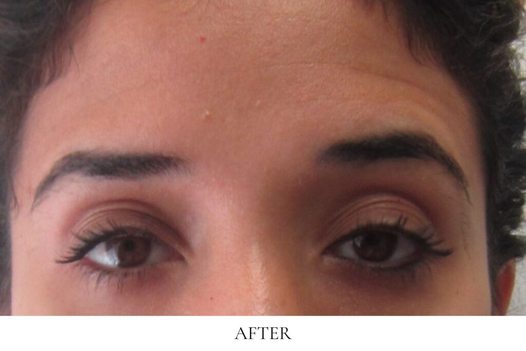 Botox before and after image