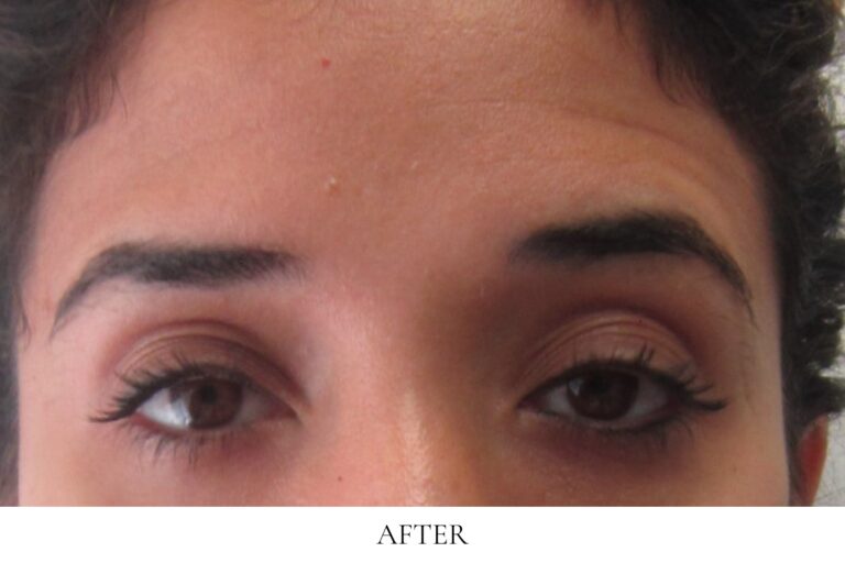 Botox before and after image